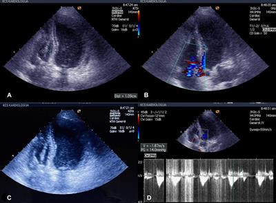 Cardiac pacemaker–related endocarditis complicated with pulmonary embolism: Case report